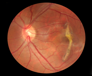 macular scarring