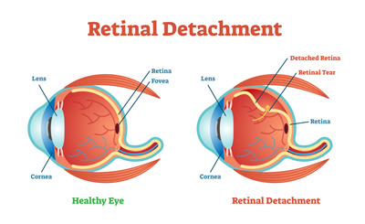 retinal detachment